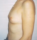 breast enhance  before